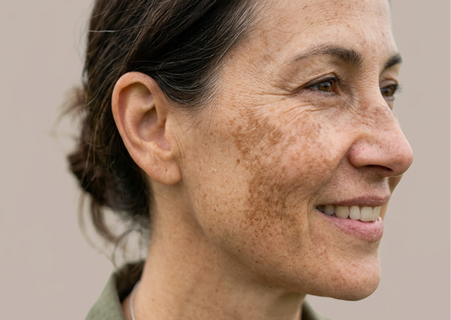 Understanding Melasma