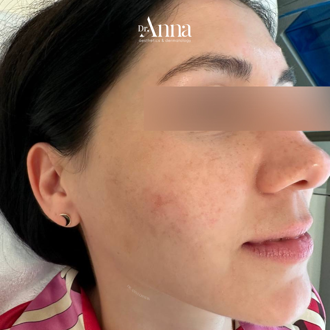 Acne-Treatment-After- Acne-Treatment-After-