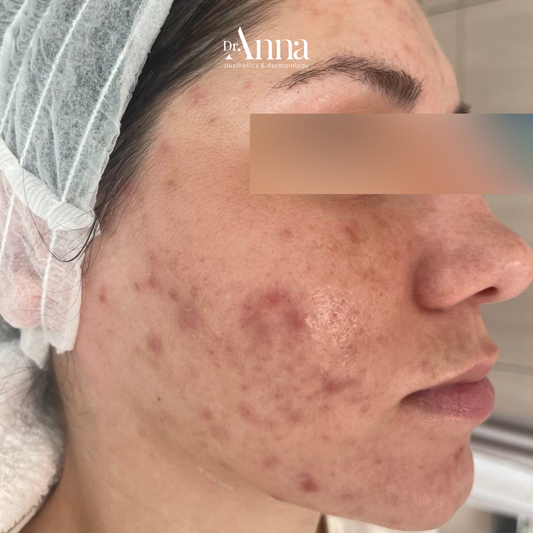 Acne-Treatment-Before- Acne-Treatment-Before-